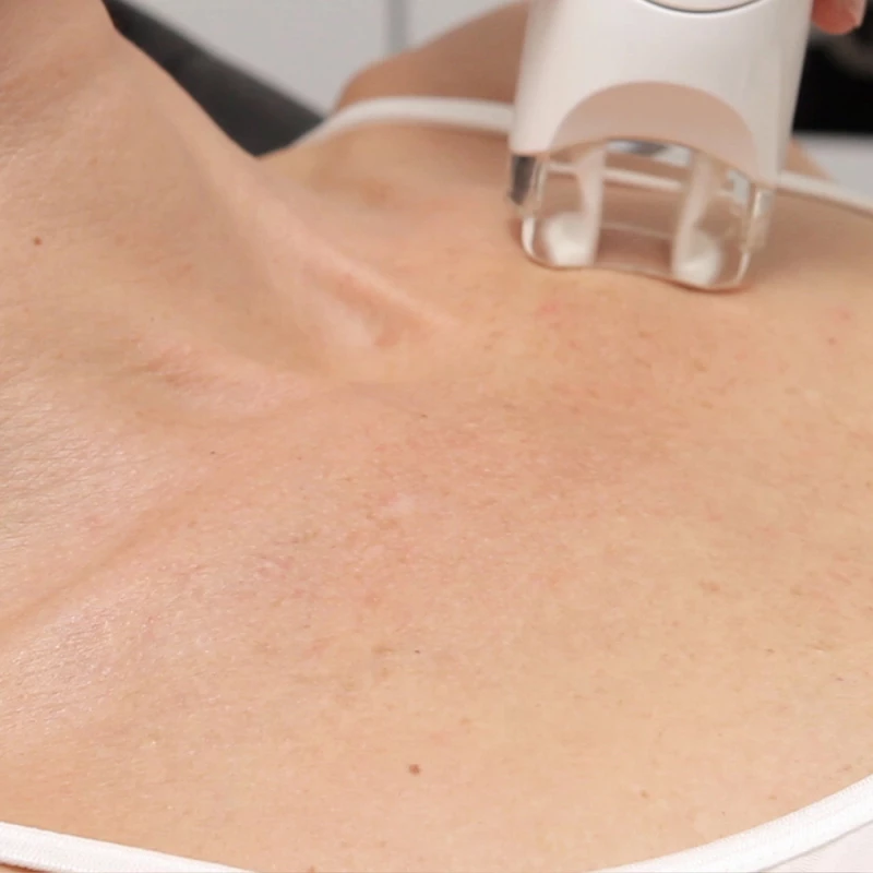 LPG Endermolift -  Soin du Visage Décolleté et Buste