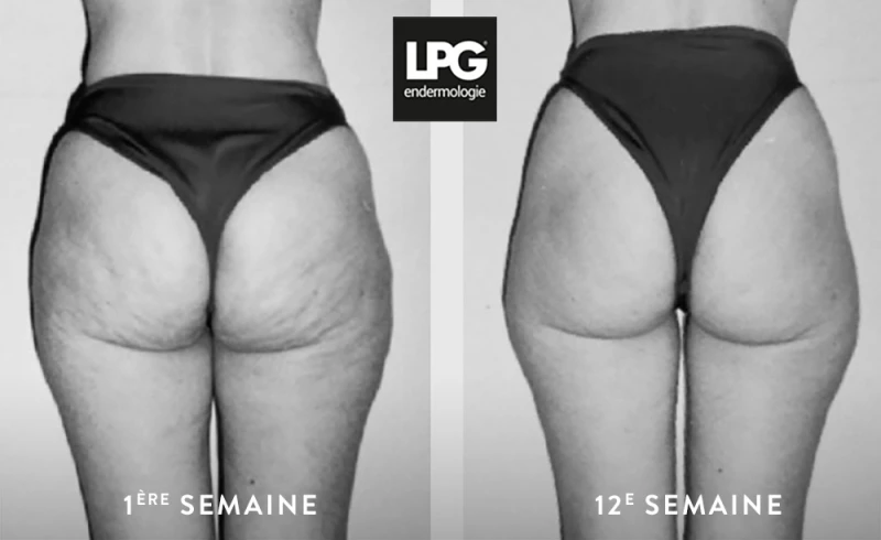 LPG Endermologie Cellu M6 - Soin Anti-Cellulite – Pack de 6 Séances (35 min.)