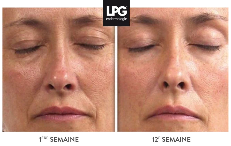 LPG  Endermolift - Pack de 6 Séances