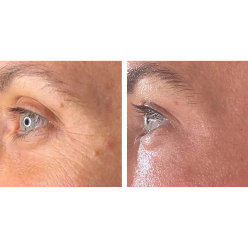 Pack d'essai JETT Plasma Lift - Lifting du Visage