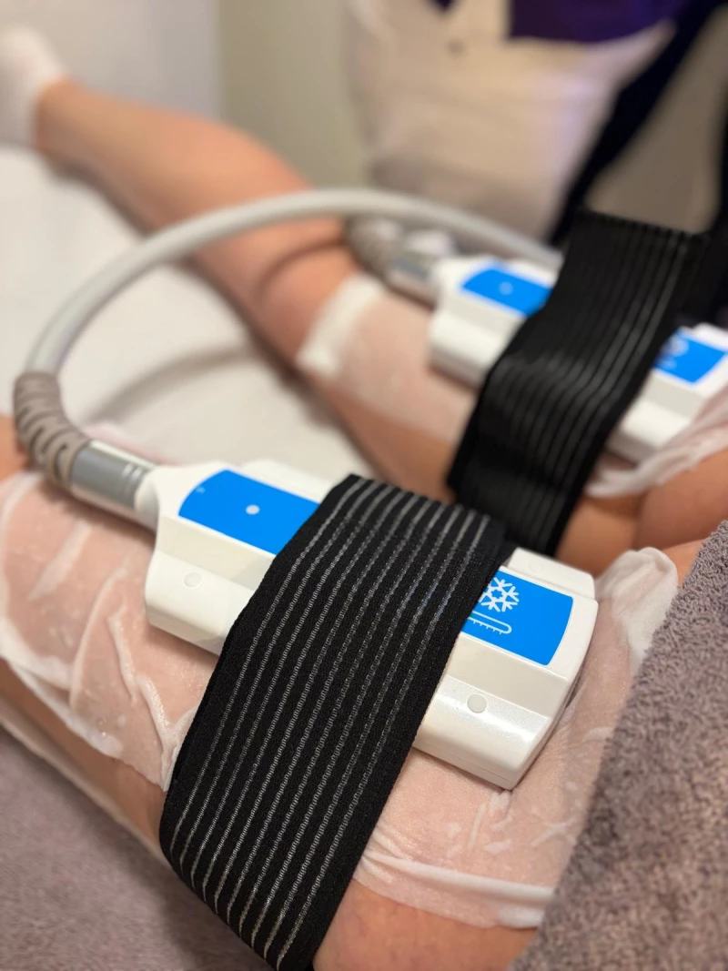 New ! Cryolipolyse 3in1 - Séance découverte